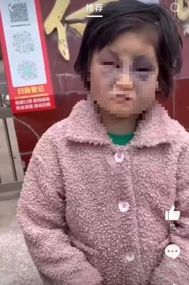 官方通报女童被母亲打成“熊猫眼”：母子分别安置